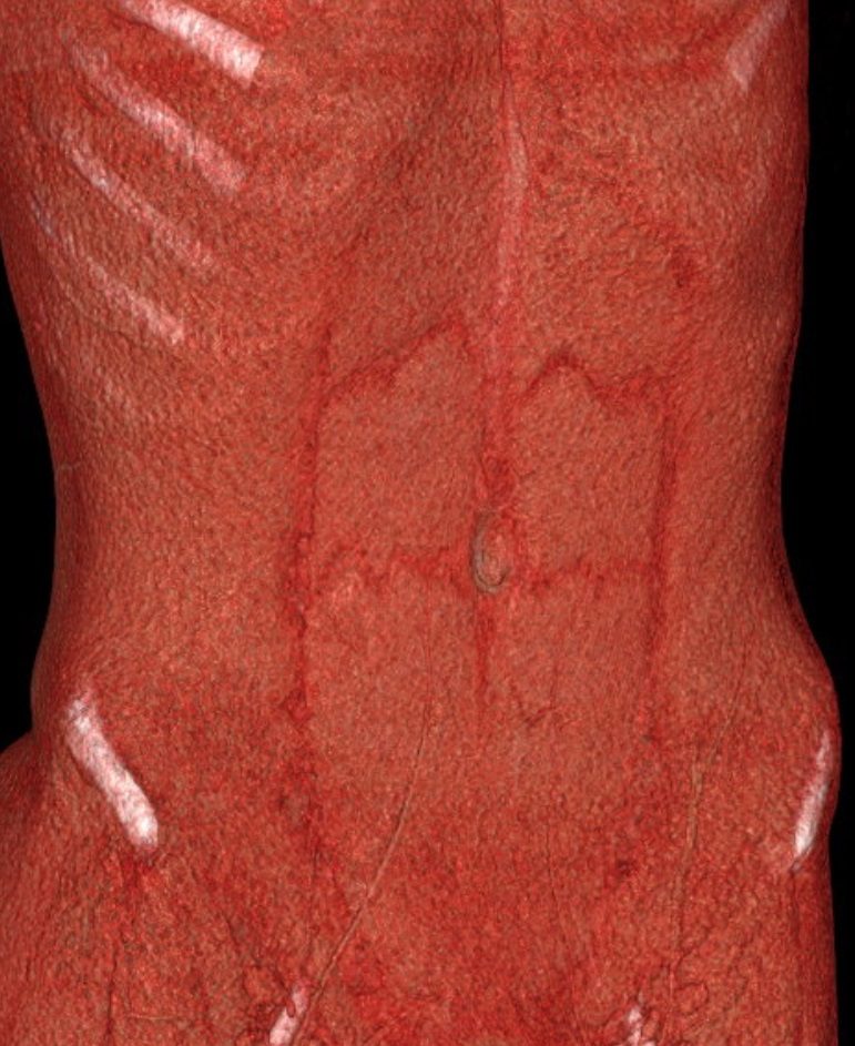 Volume rendering from a CT scan showing the abdominal muscle wall in red, with the rectus and oblique layers visible