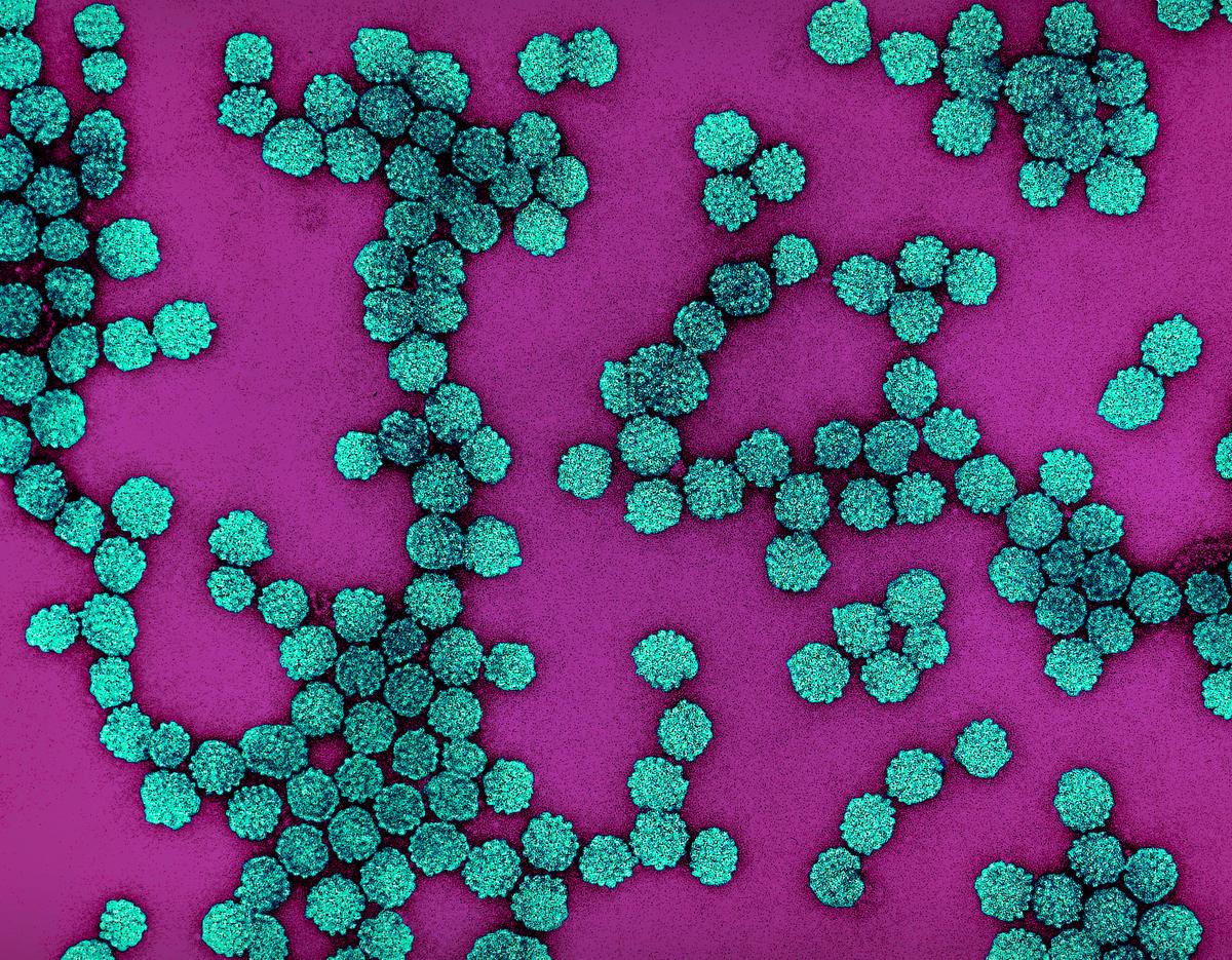 Colorized electron micrograph showing clusters of spherical human papillomavirus particles in teal against a magenta background